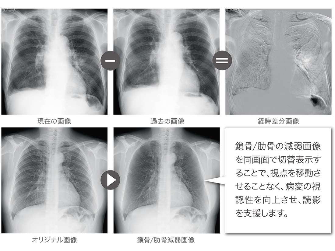BoneSuppression処理は、胸部画像から肋⾻や鎖⾻を画像処理により減弱します。