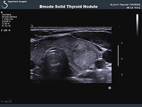 Thyroid Bmode