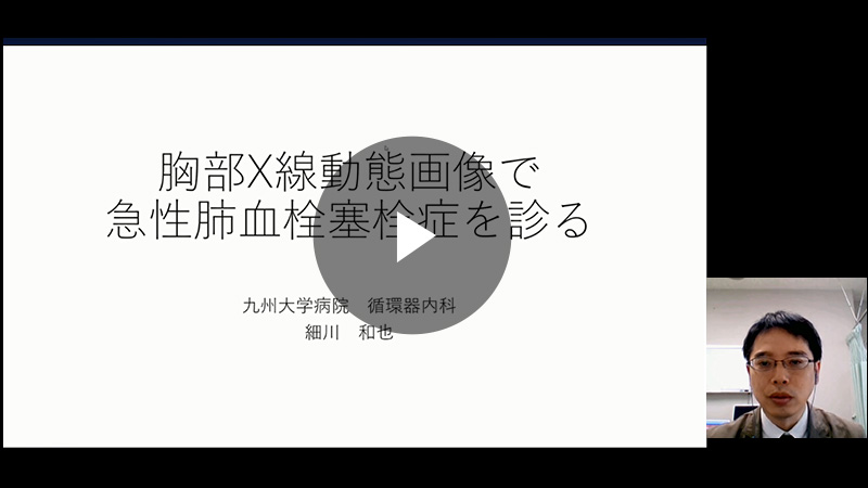 胸部X線動態画像で急性肺血栓塞栓症を診る／細川 和也先生（九州大学大学院医学研究院 循環器内科学）