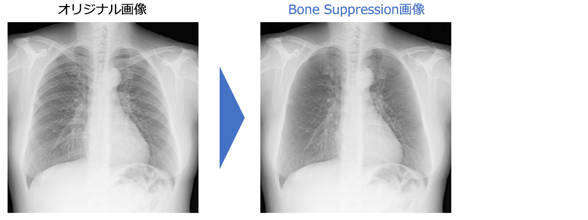 「Bone Suppression（胸部骨減弱処理）」の説明図
