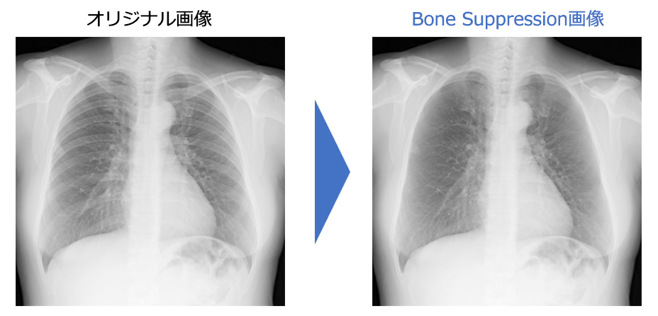 オリジナル画像 → Bone Suppressionn画像