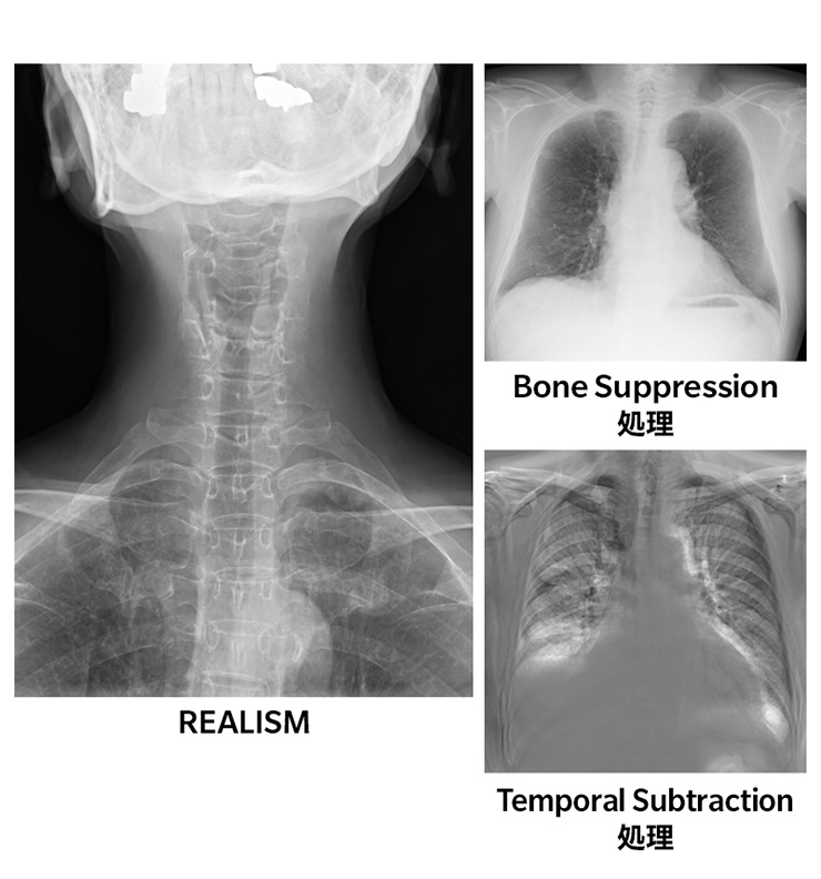 REALISM（画像処理エンジン）・Bone Suppression処理（胸部骨減弱処理）・Temporal Subtraction処理（胸部経時差分処理）