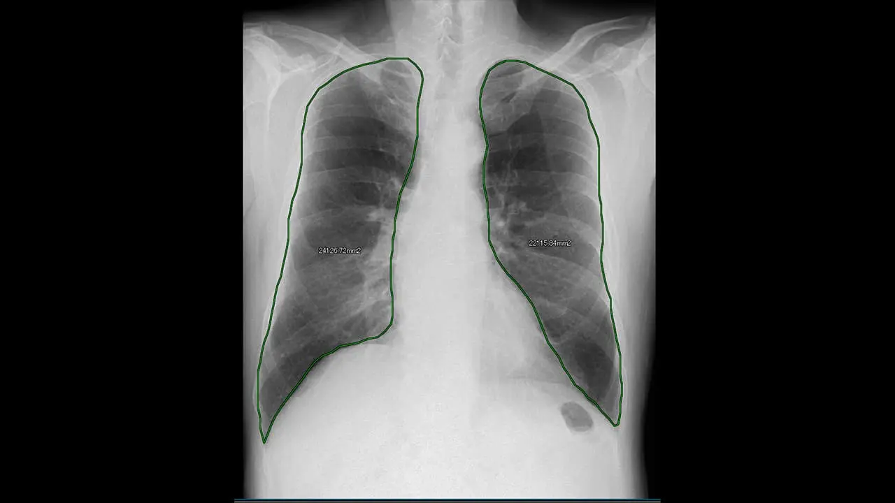 肺野面積