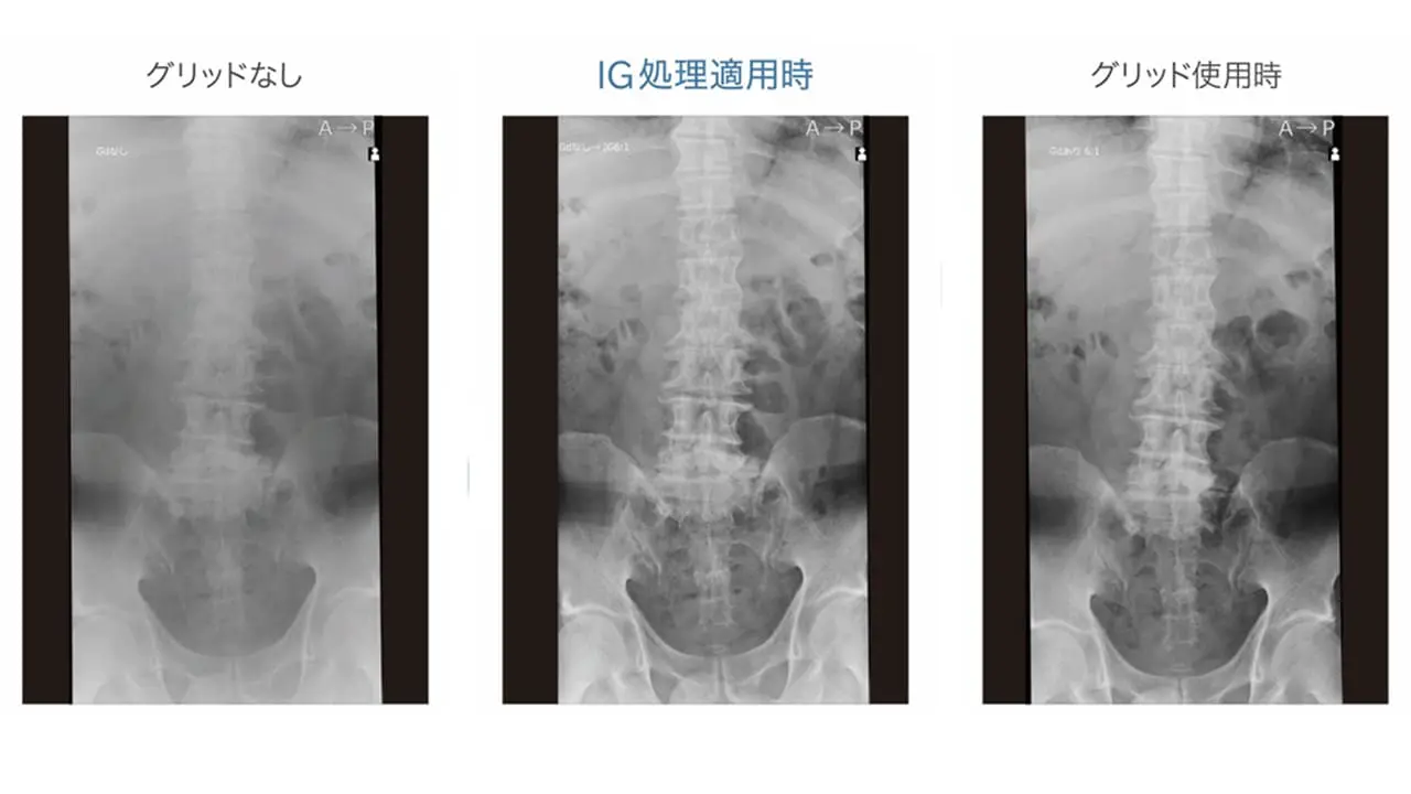 散乱線補正処理「インテリジェントグリッド」