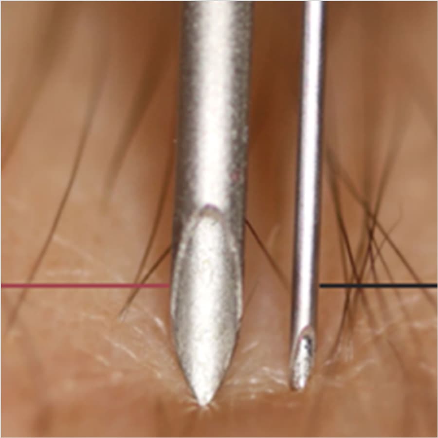 挿入に使用するニードル径が小さいため、マーカ植込み時の局所麻酔や出血・感染のリスクが少なく、患者様の体への負担を減らすことができます。