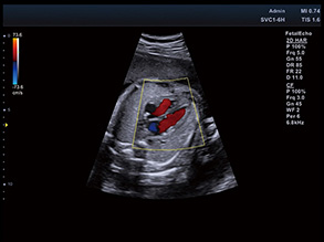 胎児心臓血流（4CV) 