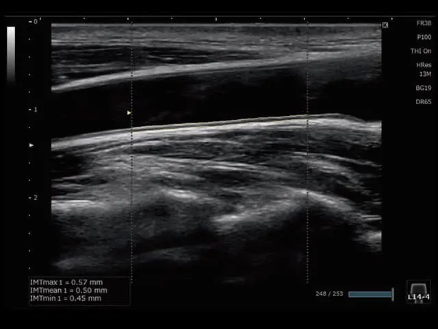 頸動脈（Auto IMT）