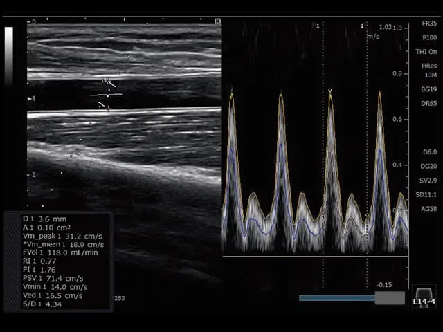 上腕動脈（フローボリューム）