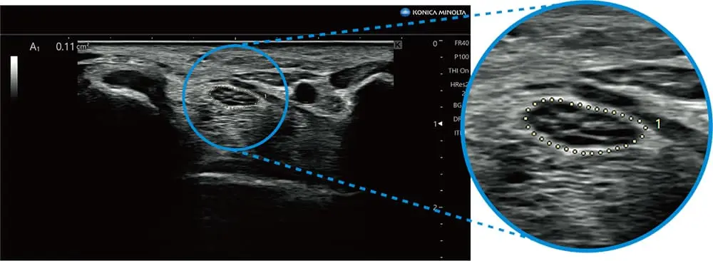 断面積（神経）セミオート機能