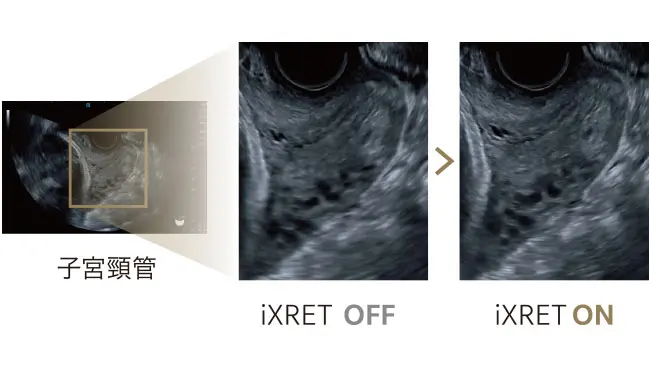 さらなる高画質の実現 iXRET®