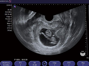 妊娠子宮（8週胎児）