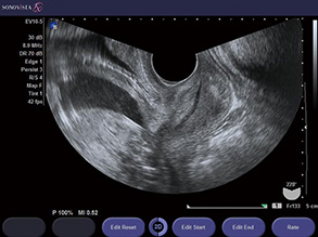 妊娠子宮（子宮頸管）