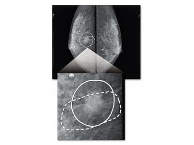 マンモグラフィー診断支援ソフトウェア MGCAD-i