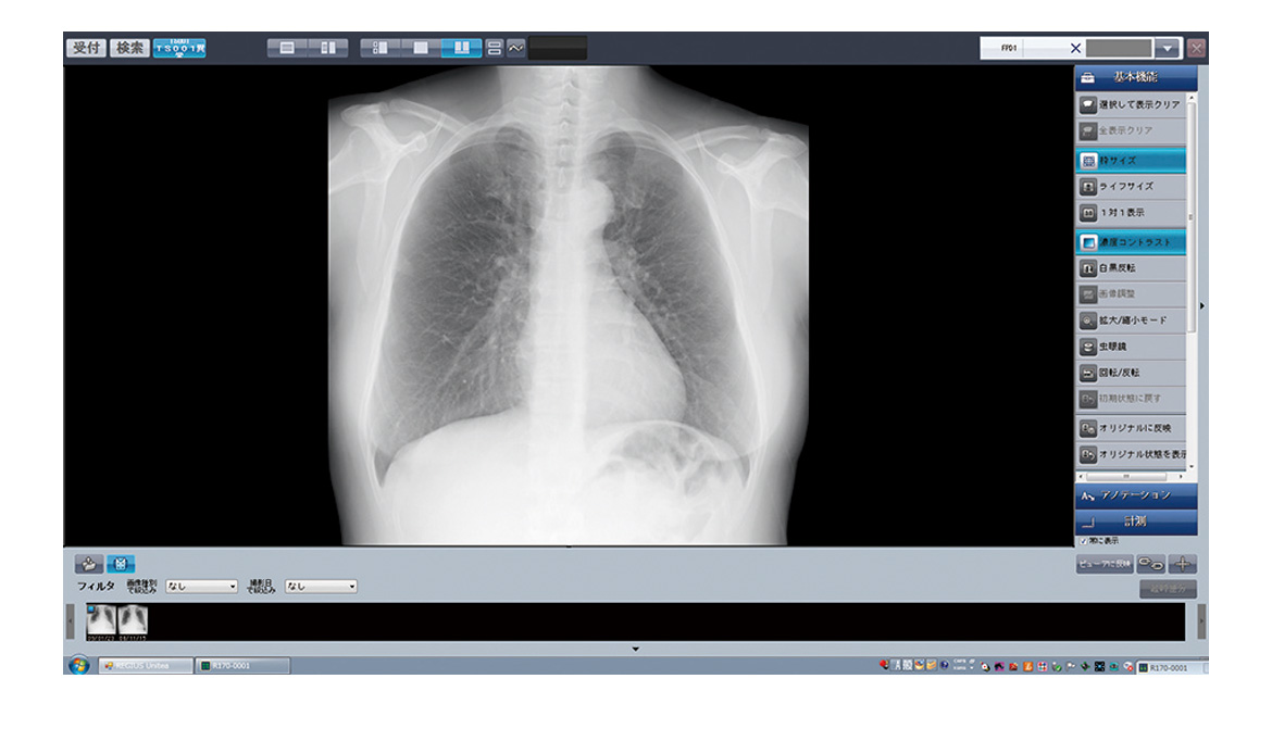 Bone Suppression処理